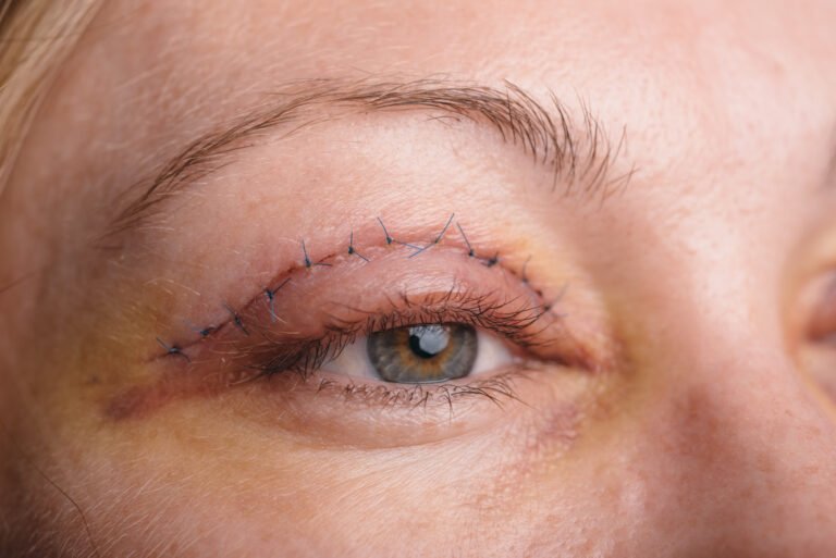 What to Expect After Your Eyelid Lift Procedure
