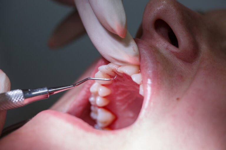 5 Things You Should Know About Gum Grafting