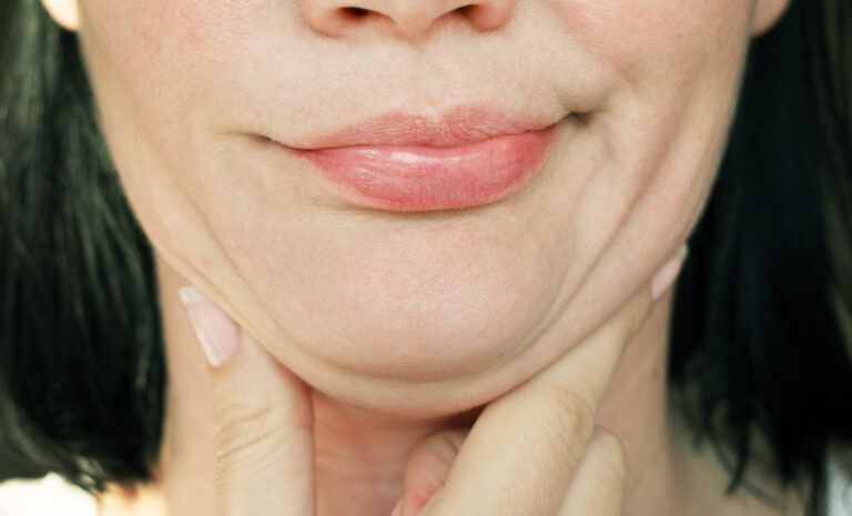 What Is Kybella? A Quick Guide